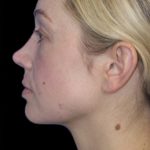 Primary Rhinoplasty Before & After Patient #839