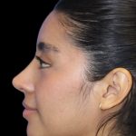 Primary Rhinoplasty Before & After Patient #840