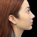 Primary Rhinoplasty Before & After Patient #858