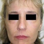 Face Lift Before & After Patient #573