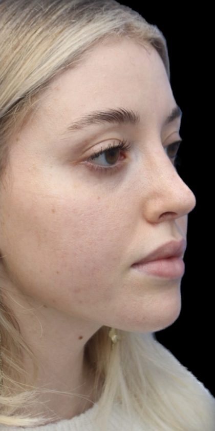 Primary Rhinoplasty Before & After Patient #857