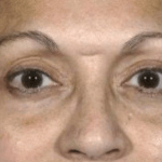 Blepharoplasty Before & After Patient #390