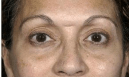 Blepharoplasty Before & After Patient #390