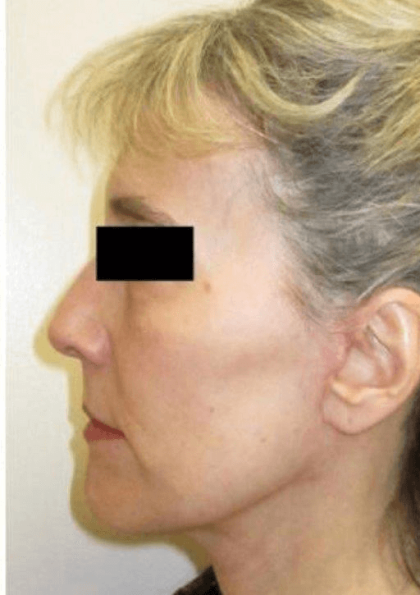 Neck Lift Before & After Patient #631