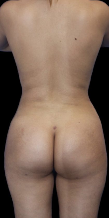 Brazilian Butt Llift Before & After Patient #403