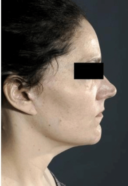 Neck Lift Before & After Patient #634