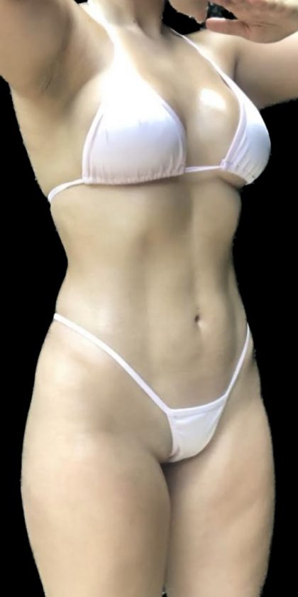 Liposuction Before & After Patient #599