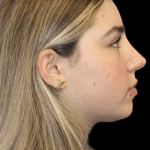 Primary Rhinoplasty Before & After Patient #806