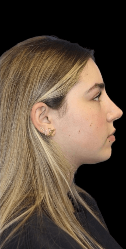 Primary Rhinoplasty Before & After Patient #806