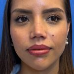 Primary Rhinoplasty Before & After Patient #1186