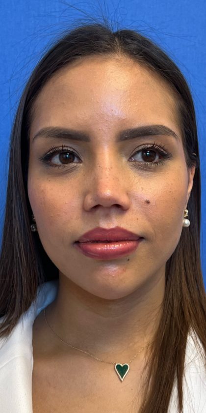 Primary Rhinoplasty Before & After Patient #1186