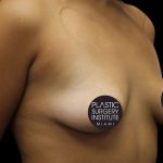 Breast Lift Before & After Patient #1183