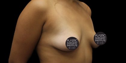 Breast Lift Before & After Patient #1183