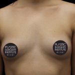 Breast Augmentation Before & After Patient #1184