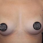 Breast Augmentation Before & After Patient #1185