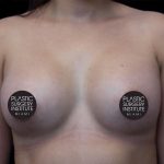 Breast Augmentation Before & After Patient #1184