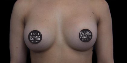 Breast Augmentation Before & After Patient #1185
