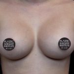 Breast Augmentation Before & After Patient #1187