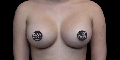 Breast Augmentation Before & After Patient #1187