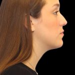 Primary Rhinoplasty Before & After Patient #1182
