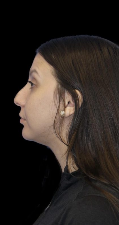 Rhinoplasty Before & After Patient #1175