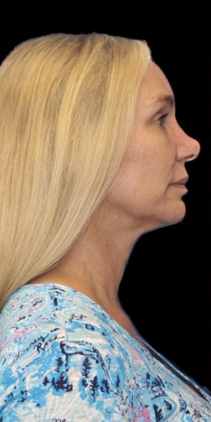 Revision Rhinoplasty Before & After Patient #1178
