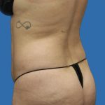 Brazilian Butt Llift Before & After Patient #1179