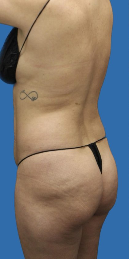 Brazilian Butt Llift Before & After Patient #1179