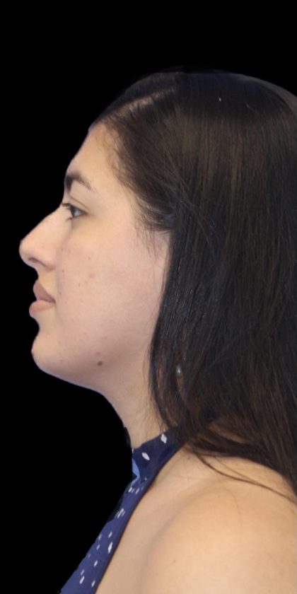Primary Rhinoplasty Before & After Patient #1181