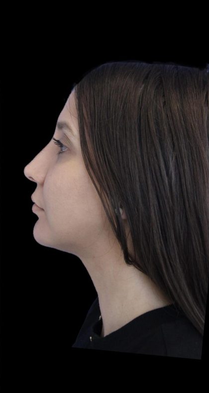 Rhinoplasty Before & After Patient #1175