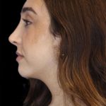 Rhinoplasty Before & After Patient #1176