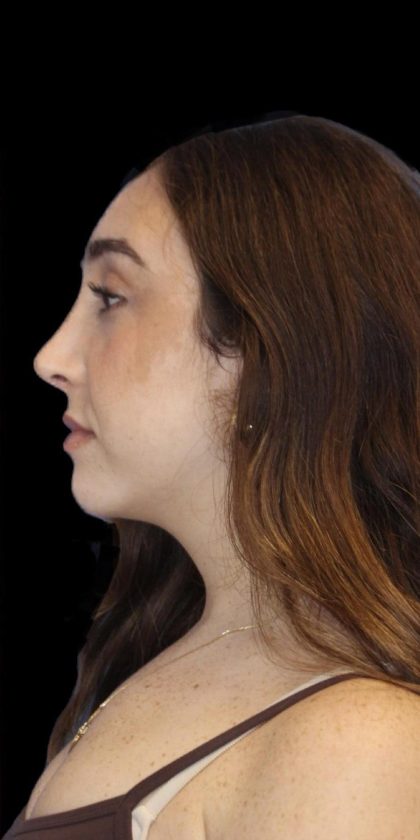 Rhinoplasty Before & After Patient #1176