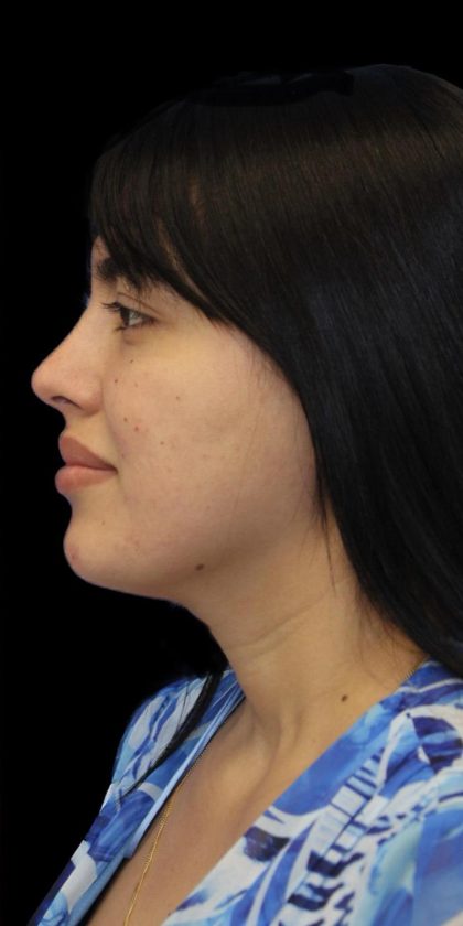 Primary Rhinoplasty Before & After Patient #1181