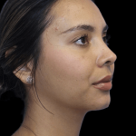 Rhinoplasty Before & After Patient #1321