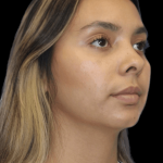 Rhinoplasty Before & After Patient #1321