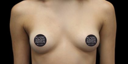 Breast Augmentation Before & After Patient #1328