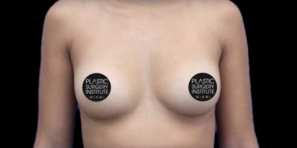 Breast Augmentation Before & After Patient #1329