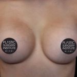 Breast Augmentation Before & After Patient #1330