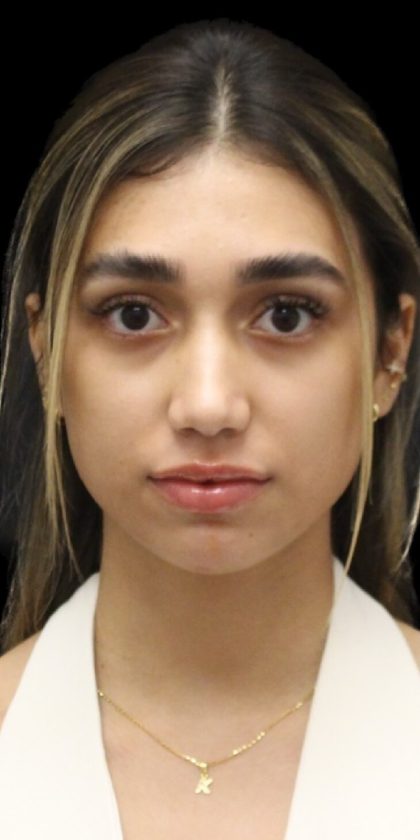Rhinoplasty Before & After Patient #1322