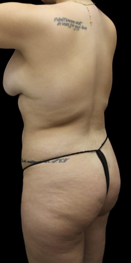 Brazilian Butt Llift Before & After Patient #1384