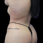 Brazilian Butt Lift Before & After Patient #1384