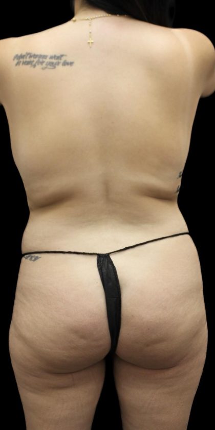 Brazilian Butt Llift Before & After Patient #1384