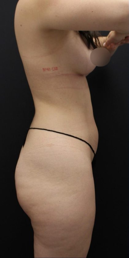 Brazilian Butt Llift Before & After Patient #1386