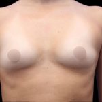Breast Augmentation Before & After Patient #1373