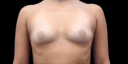 Breast Augmentation Before & After Patient #1373