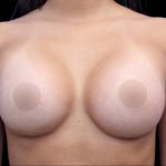 Breast Augmentation Before & After Patient #1373