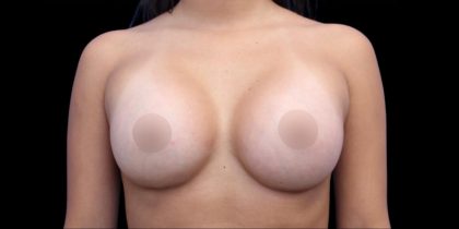 Breast Augmentation Before & After Patient #1373