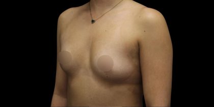 Breast Augmentation Before & After Patient #1375