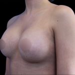 Breast Augmentation Before & After Patient #1375