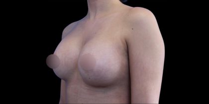 Breast Augmentation Before & After Patient #1375